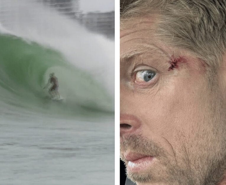 Mick Fanning's gruesome injury (right) and how he would have been forced to see the world had it been any closer to his eyeball. Photo: Instagram